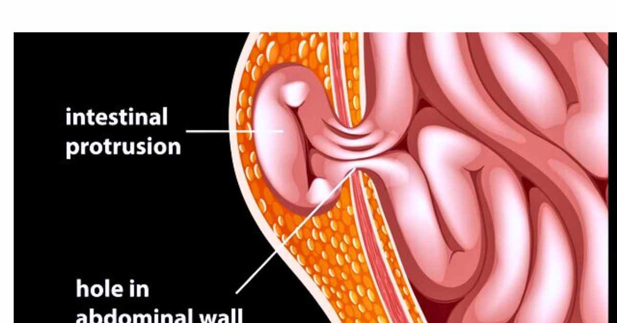 Types of hernia in males : What is Hernia And Treatments 
